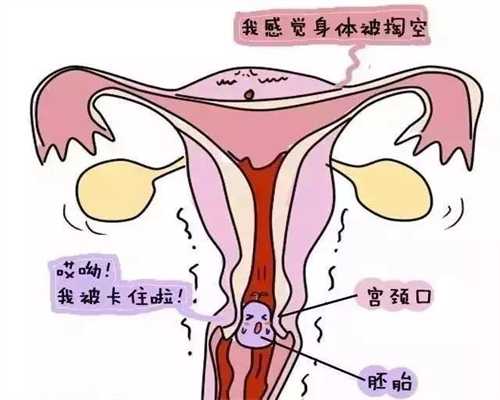 做试管代孕婴儿出现宫外孕早期的症状有哪些